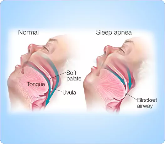 INSOMNIA TREATMENT in Pune 